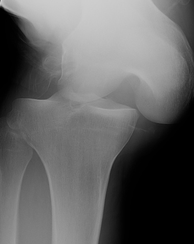 Knee dislocation